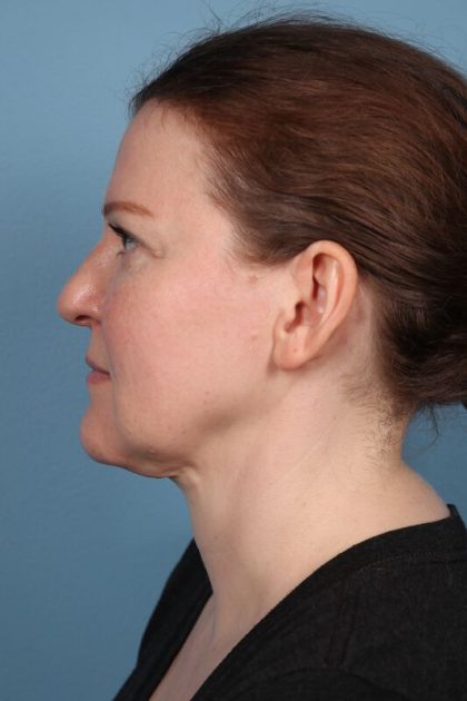 Face & Neck Lift Before & After Image