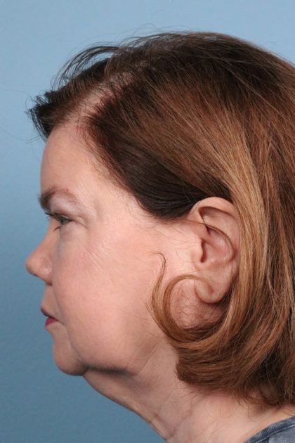 Facelift Before & After Image