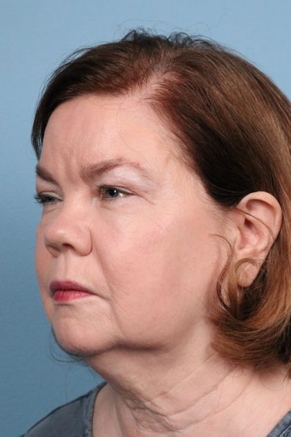 Facelift Before & After Image