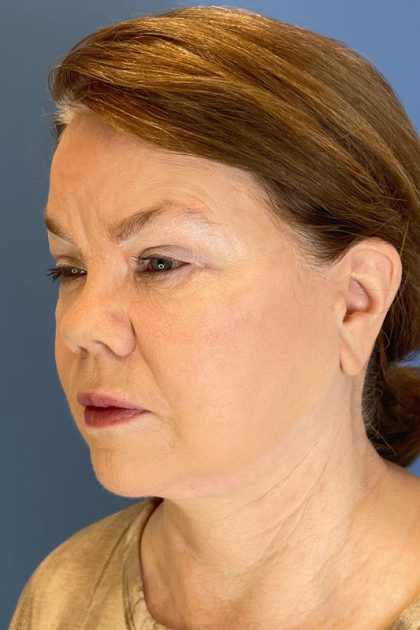 Facelift Before & After Image