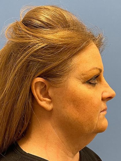 Facelift Before & After Image