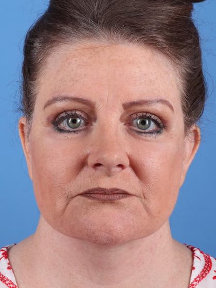 Facelift Before & After Image