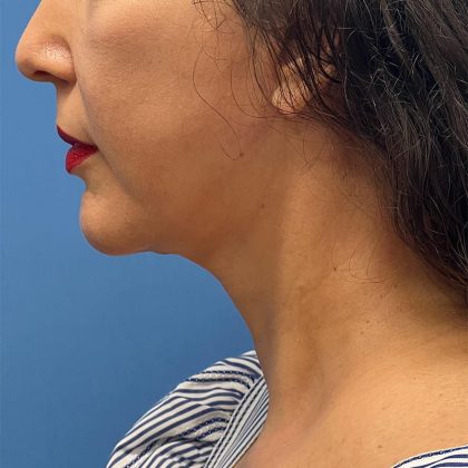 Facelift Before & After Image