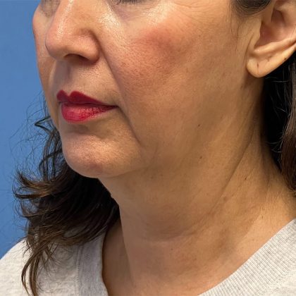 Facelift Before & After Image