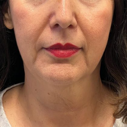 Facelift Before & After Image