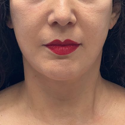 Facelift Before & After Image