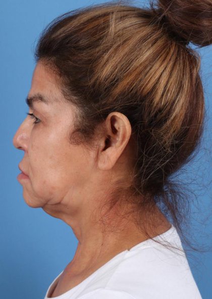 Facelift Before & After Image