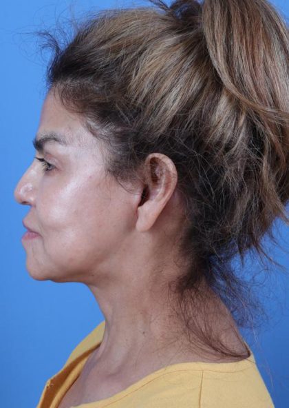 Facelift Before & After Image