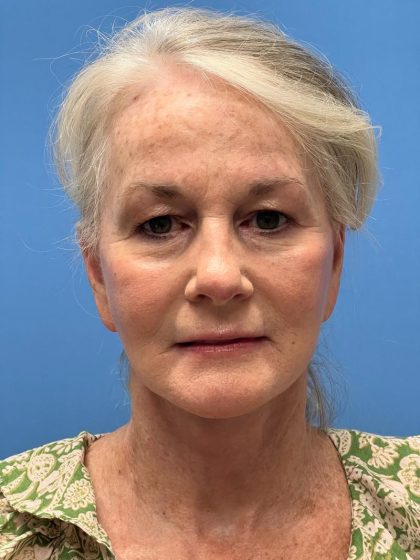 Facelift Before & After Image