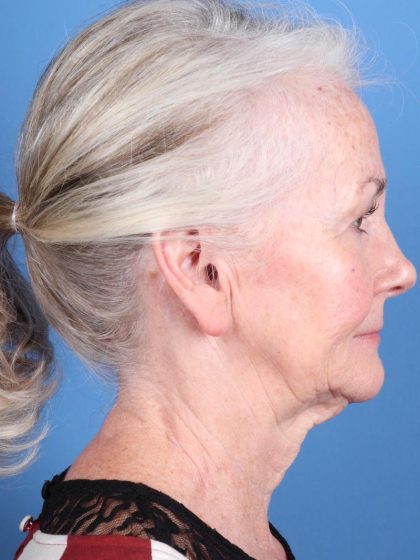 Facelift Before & After Image