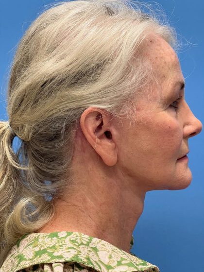 Facelift Before & After Image