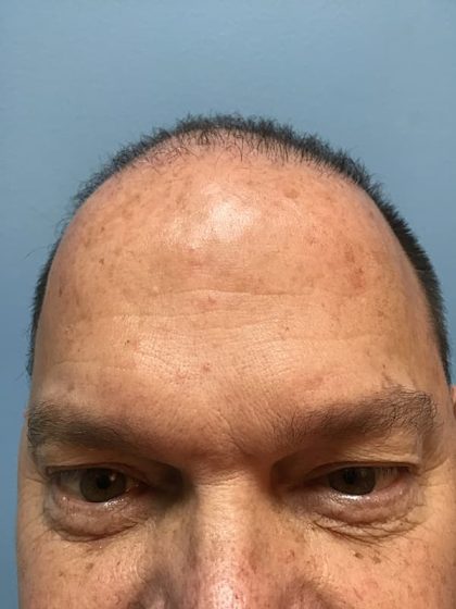 Hair Transplant Before & After Image