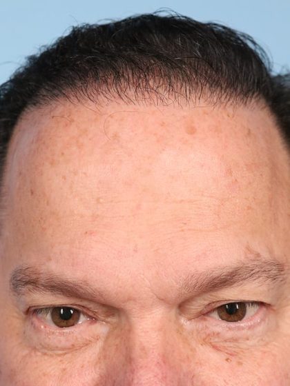 Hair Transplant Before & After Image