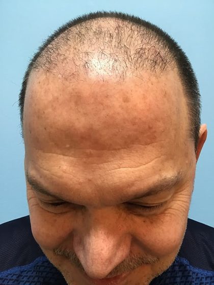 Hair Transplant Before & After Image