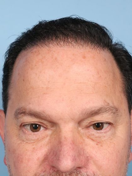 Hair Transplant Before & After Image