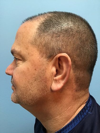 Hair Transplant Before & After Image