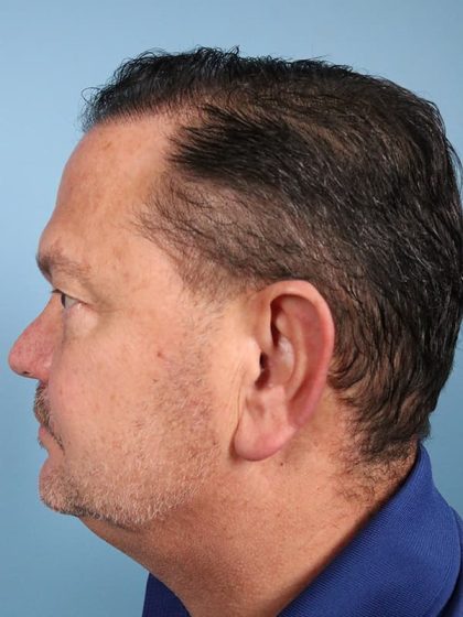 Hair Transplant Before & After Image