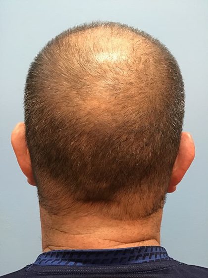 Hair Transplant Before & After Image