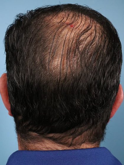 Hair Transplant Before & After Image