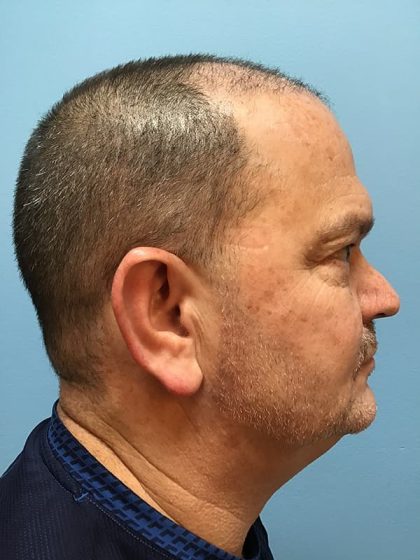 Hair Transplant Before & After Image