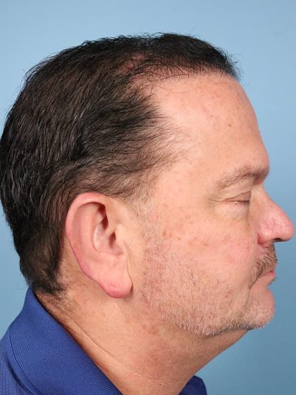 Hair Transplant Before & After Image