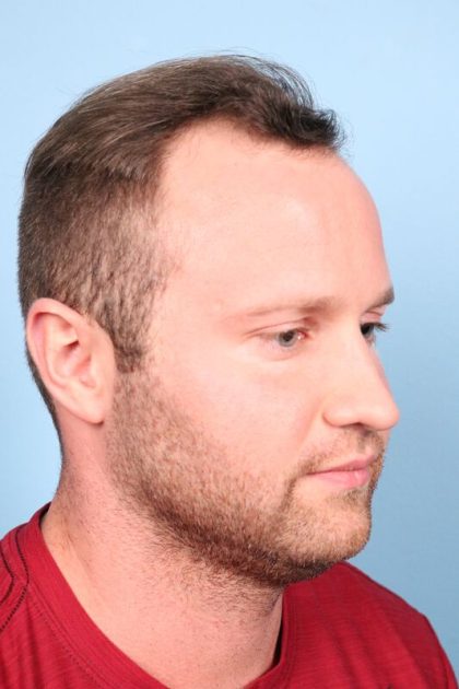 Hair Transplant Before & After Image