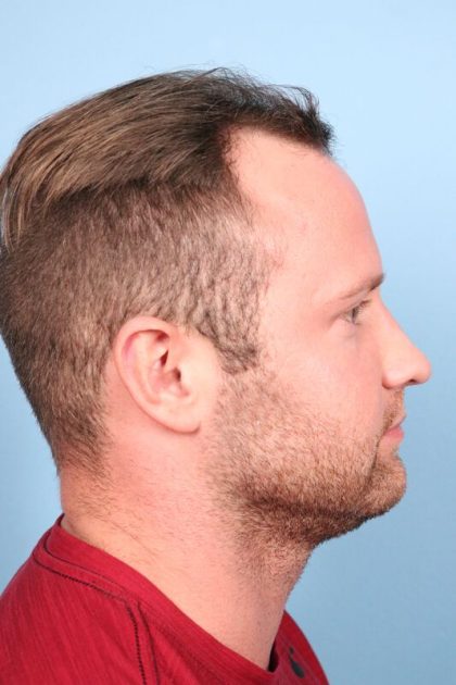 Hair Transplant Before & After Image