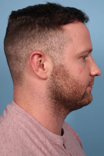 Hair Transplant Before & After Image