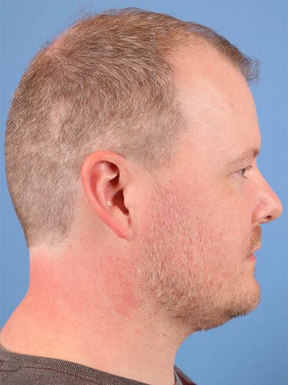 Hair Transplant Before & After Image