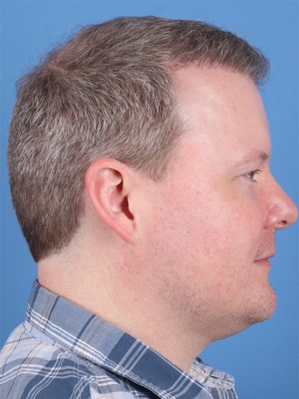 Hair Transplant Before & After Image