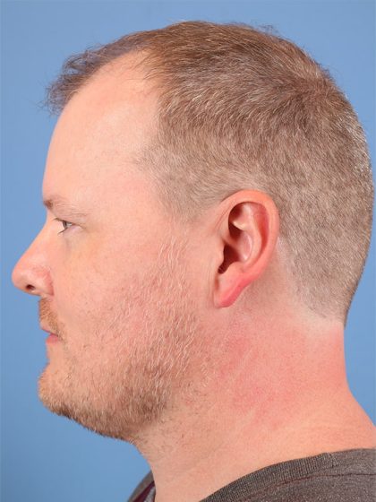 Hair Transplant Before & After Image