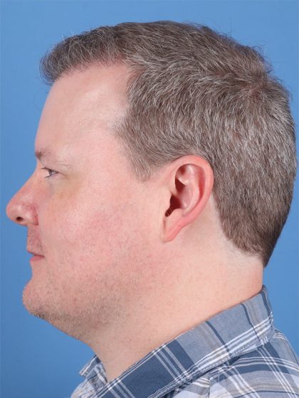 Hair Transplant Before & After Image