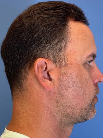 Hair Transplant Before & After Image