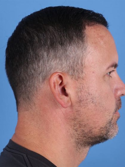 Hair Transplant Before & After Image