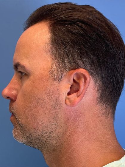 Hair Transplant Before & After Image