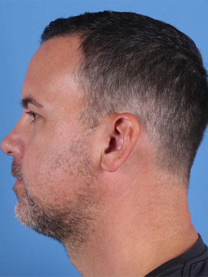 Hair Transplant Before & After Image