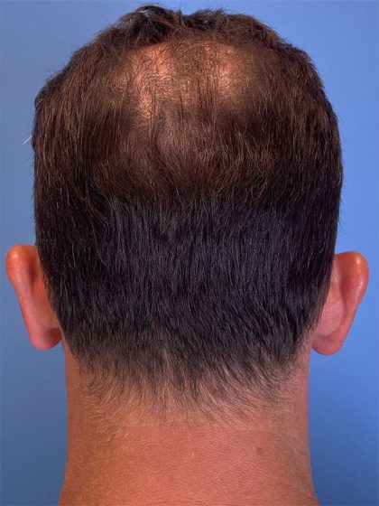 Hair Transplant Before & After Image