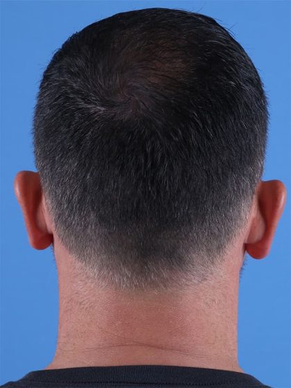 Hair Transplant Before & After Image