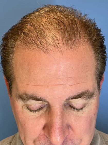 Hair Transplant Before & After Image