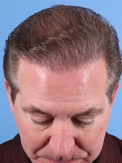 Hair Transplant Before & After Image