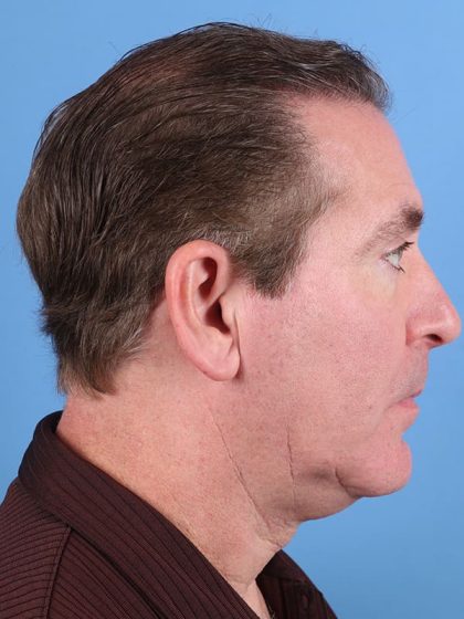 Hair Transplant Before & After Image