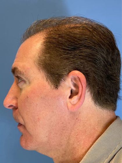 Hair Transplant Before & After Image