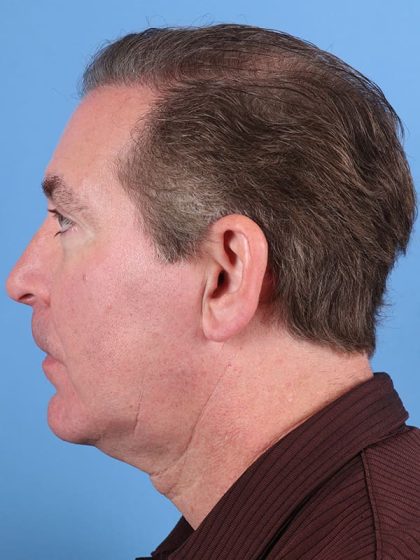 Hair Transplant Before & After Image