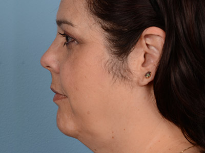 Neck Submental Liposuction Before & After Image