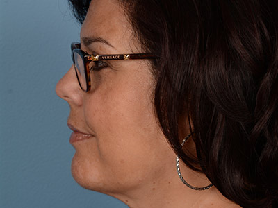 Neck Submental Liposuction Before & After Image