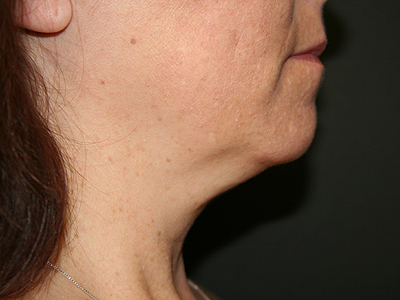 Neck Submental Liposuction Before & After Image