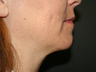 Neck Submental Liposuction Before & After Image