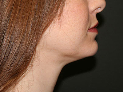 Neck Submental Liposuction Before & After Image