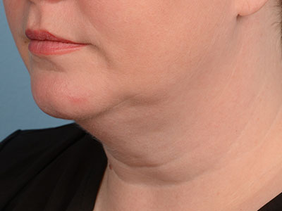 Neck Submental Liposuction Before & After Image