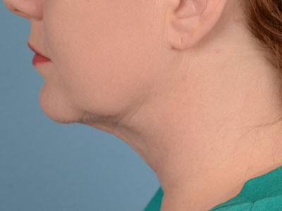 Neck Submental Liposuction Before & After Image